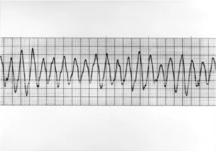 Figure 1.  Ventricular tachycardia on electrocardiography.