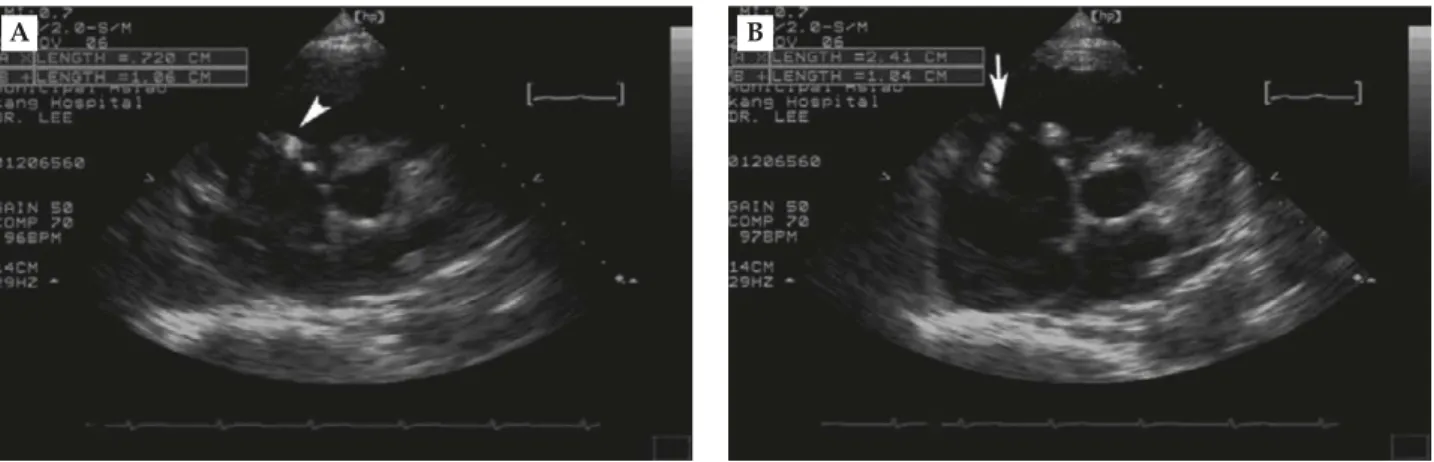 Figure 2. Echocardiography: parasternal short axis view. Two vegetations are shown. (A) Vegetation A (0.72 × 1.06 cm) was observed