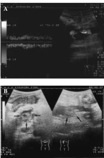 Figure 1.  (A) Color Doppler ultrasonography shows partial