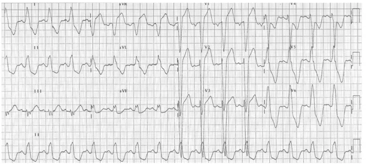 Figure 1. Initial electrocardiogram revealed complete left bundle branch block.