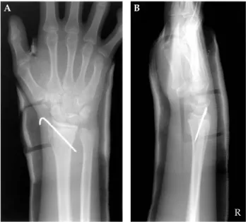 Figure 3. Eight weeks after the injury, solid union of the fracture was achieved: (A) anteroposterior view; (B) lateral view.