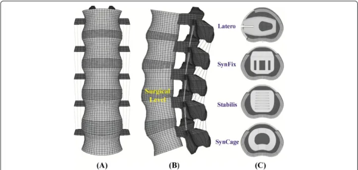 Figure 2 The lumbar finite-element model used in this study. (A) Intact model from L1 to L5 levels