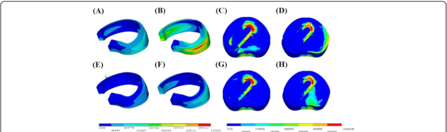 Figure 7 The maximum von Mises stress of pedicle screws in all models. (1 = with unilateral pedicle screws fixation; 2 = with bilateral pedicle screw fixation) (FL = Flexion; EX = Extension; LLB = Left lateral bending; RLB = Right lateral bending; LAR = Le