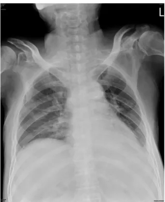 Figure 1. The initial Chest X-ray of the patient.