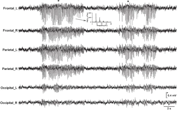 Fig. 1. A representative example of spontaneous SWDs. Paroxysmal SWDs (*) were prominent and bilaterally synchronous in the frontal and parietal
