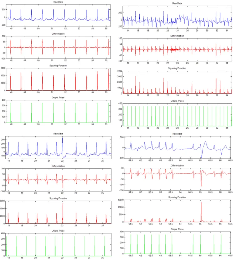 Fig. 10. Beat detection of ECG signals with different types of distortion.