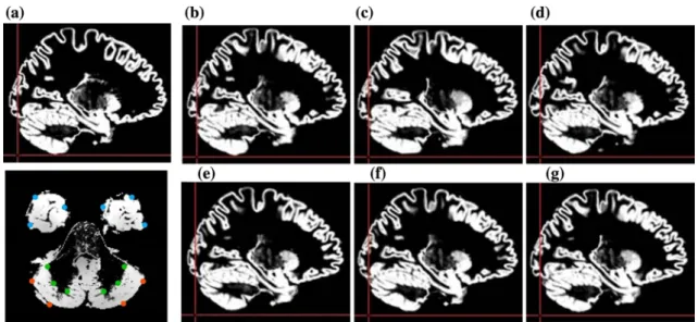 FIGURE 9. The construction of simulated images with different degrees of volume difference in the cerebellum