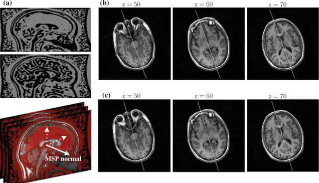 FIGURE 4. Brain MSP estimation and refinement. (a) TDOG image is more planarly distributed nearby the MSP (top), compared to other regions (middle)
