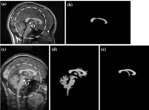 FIGURE 5. Segmentation of CC on MSP. (a) The circular area centered at the gravity of brain MSP, O, is considered in the segmentation of CC