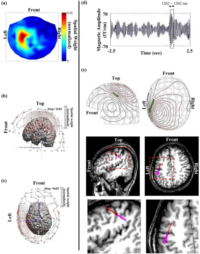 Fig. 8. Overlay of extracted reactive beta activities on MR image. (a) Spatial map reconstructed using x ជ recon ⫽ ⌺ j k ⫽1 x ជ j (see Materials and methods)