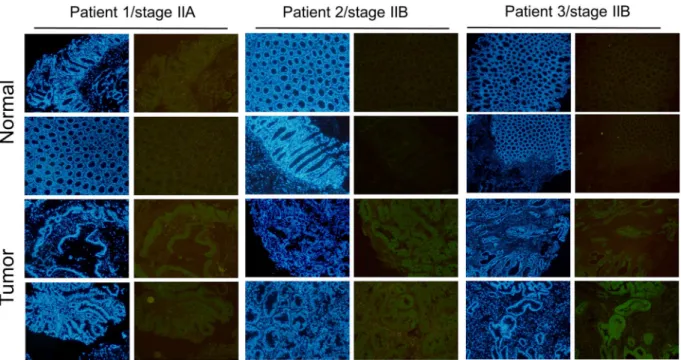 Figure 8.  Increased Musashi-1 expression in CRC cells. Paired clinical samples (one stage IIA and two stage IIB 