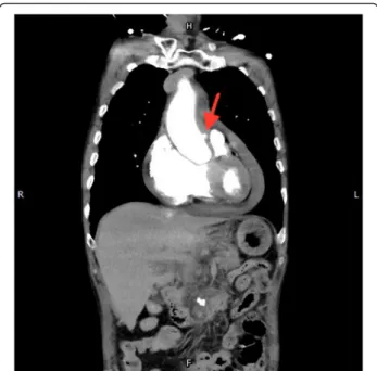 Fig. 1 A protruding spot (PAU) in the ascending aorta, coronal view (red arrow)
