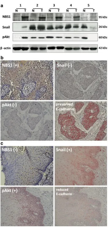 FIG. 2 a Western blot of NBS1, Snail, and pAkt in tumorous (T) and nontumorous (N) tissue pairs from five representative patients with NBS1 overexpression in ESCC