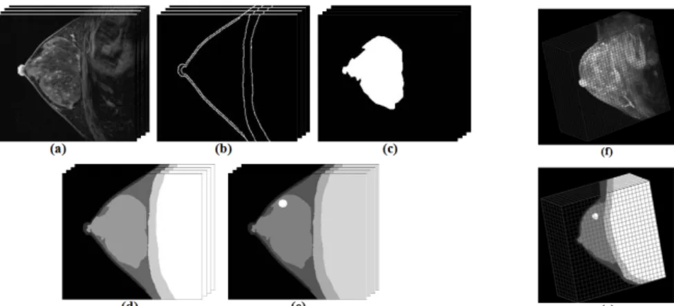 Figure 1. The three-dimension model of human breast: (a) MRI image, (b) boundary image, (c) glandular layer, (d) breast model with  five layers, (e) a tumor in breast, (f) in vivo 3-D MRI image, and (g) 3-D breast modeling