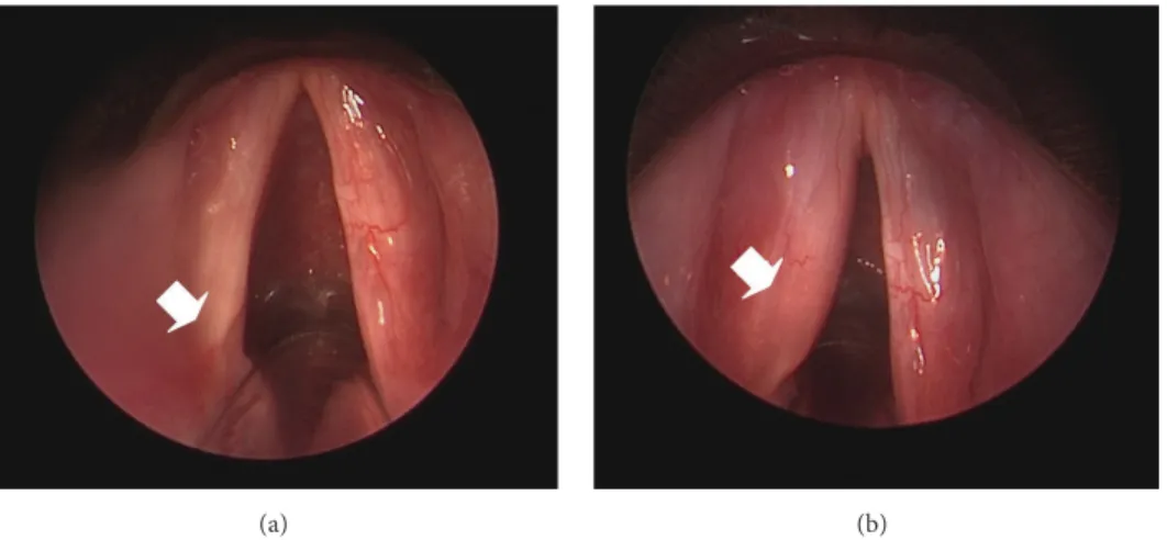 Figure 1: Paralyzed vocal fold before (a) and after (b) autologous fat for injection laryngoplasty.