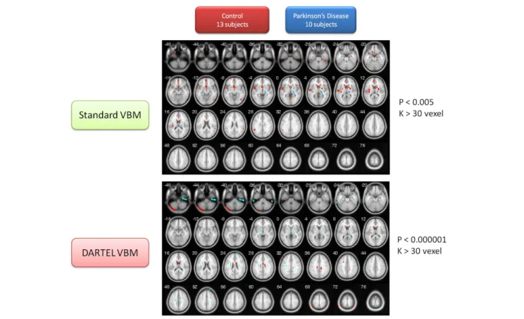 FIGURE 2 | Contrast maps of volume changes between healthy controls and Parkinson’s disease with two VBM methods