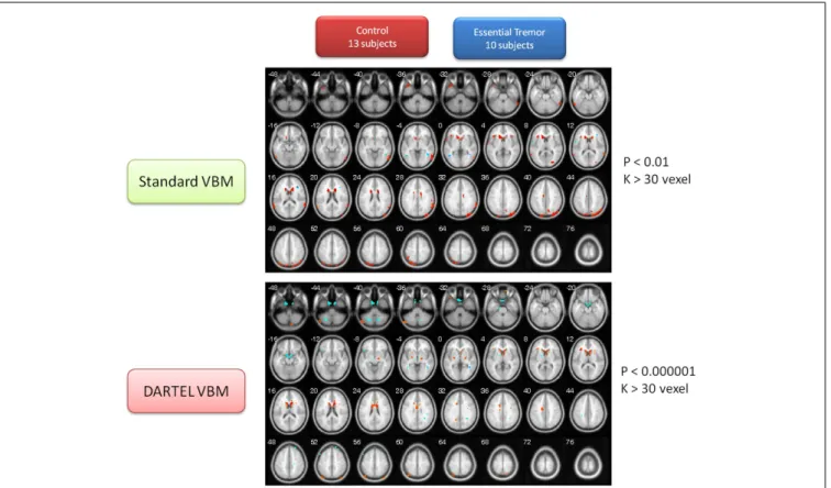 FIGURE 3 | Contrast maps of volume changes between healthy controls and essential tremors with two VBM methods