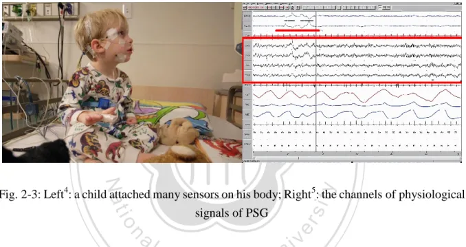 Fig. 2-3: Left 4 : a child attached many sensors on his body; Right 5 : the channels of physiological  signals of PSG 