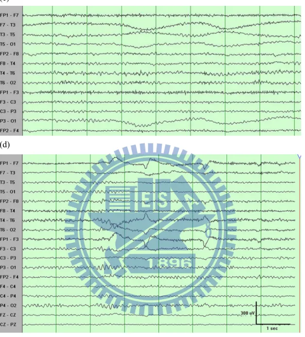 Figure 2-6: The artifacts were existed in the EEG signals. (a): Artifacts were  generated from the bad channel T7