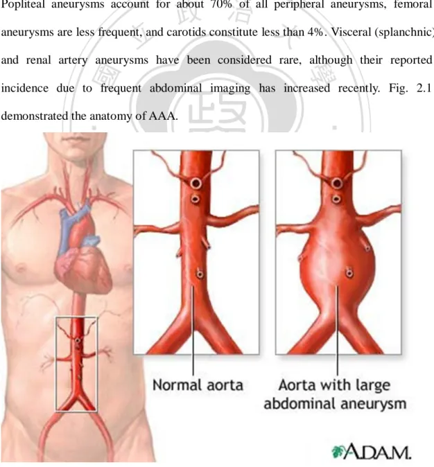 Figure 2.1 Illustration of abdominal aortic aneurysm. (source: “MedlinePlus‖) 