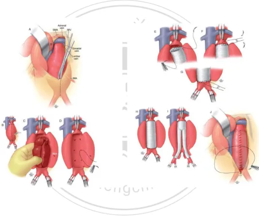Figure 2.2 Operative techniques of trasnperitoneal abdominal aortic aneurysm repair  with a straight or a bifurcated prosthetic graft
