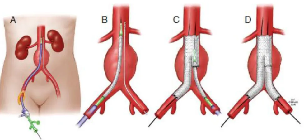 Figure 2.3 Techniques of endovascular aortic repair. (source: Sabiston Textbook of  Surgery, 18th Edition) 