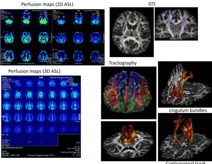 圖 十五：擴散權重影像(Diffusion MRI)、擴散張量影像(Diffusion Tensor  MRI)及微灌流影像(Perfusion MRI)  DTI  Corticospinal track  cingulum bundles Tractography Perfusion maps (3D ASL) Perfusion maps (2D ASL) 