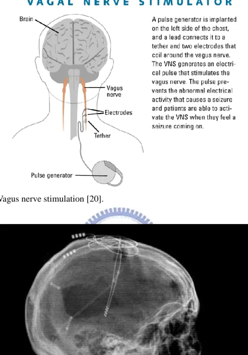Fig. 2.4. Vagus nerve stimulation [20]. 