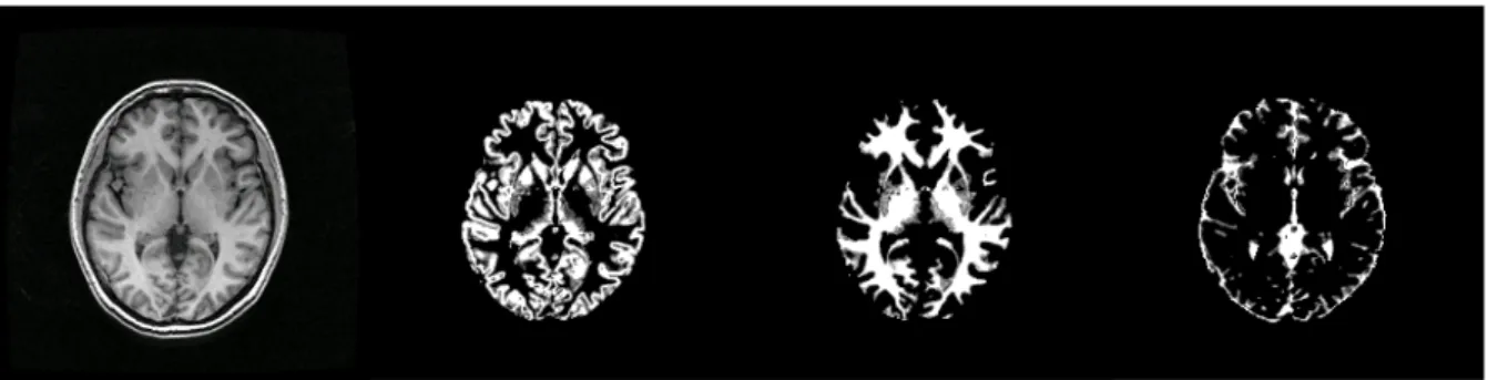 Figure 1.1: Anatomical image from left to right are original image, GM, WM and CSF.