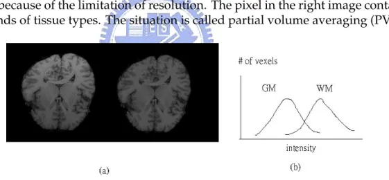 Figure 1.5: (a) It shows the MRI with inhomogeneities (left) and normal MRI (right). Obviously,the intensities of the WM in the upper are brighter than those in the bottom