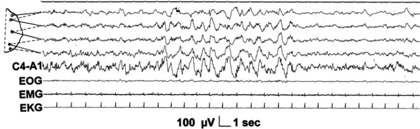 Figure 1.3: Delta burst. Top 4 channels is Bioplolar parasagittal EEG derivation of the right side : FP2F4 , F4C4 , C4P4 , P4O2; C4A1: C4 connects to left ear (A1); EOG:  Elec-trooculogram; EMG: Electromyogram; EKG: Electrocardiogram
