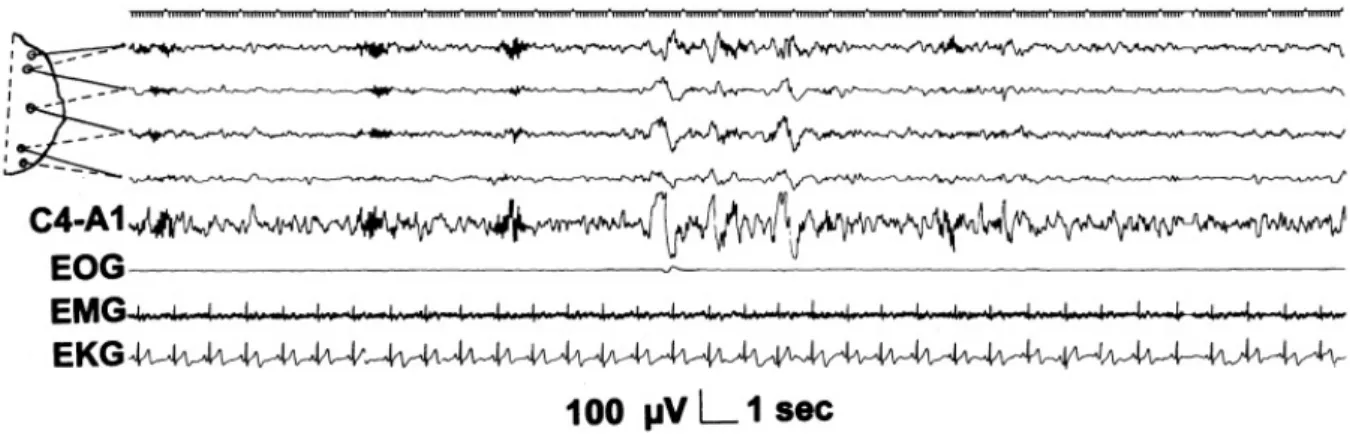 Figure 1.5: K-complexes sequences associated with spindles. Top 5 channels: EEG deriva- deriva-tion as in Figure 1.3 (Figure source: Sleep Medicine 3, Consensus Report, Mario Giovanni Terzano et al.: Atlas, rules, and recording techniques for the scoring o