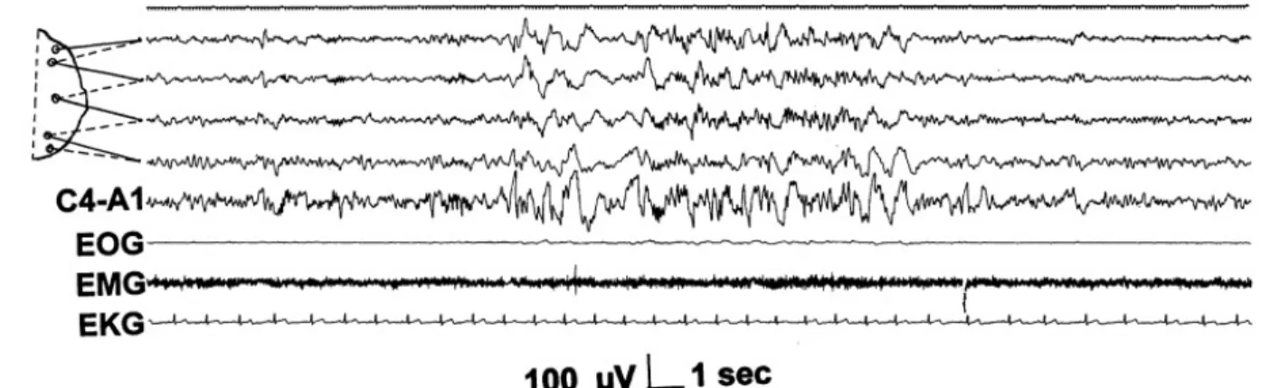 Figure 1.6: Polyphasic burst in stage 2 sleep. Top 5 channels: EEG derivation as in Fig- Fig-ure 1.3 (FigFig-ure source: Sleep Medicine 3, Consensus Report, Mario Giovanni Terzano et al.: Atlas, rules, and recording techniques for the scoring of cyclic alt
