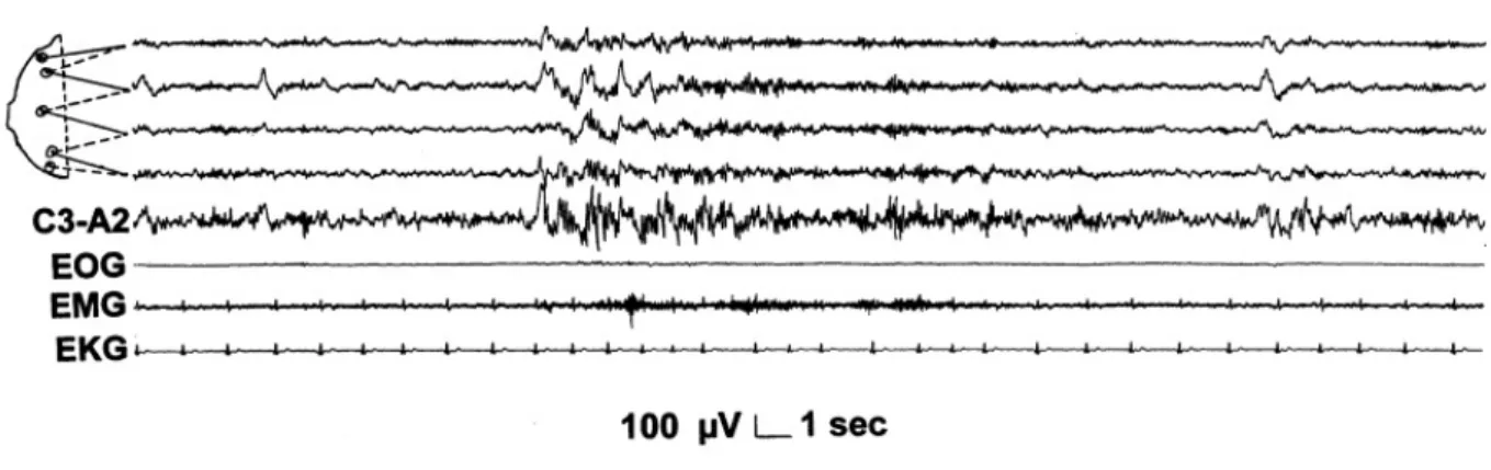 Figure 1.7: K-alpha complex in stage 2 sleep. Top 5 channels: EEG derivation as in Figure 1.4 (Figure source: Sleep Medicine 3, Consensus Report, Mario Giovanni Terzano et al.: Atlas, rules, and recording techniques for the scoring of cyclic alternating pa