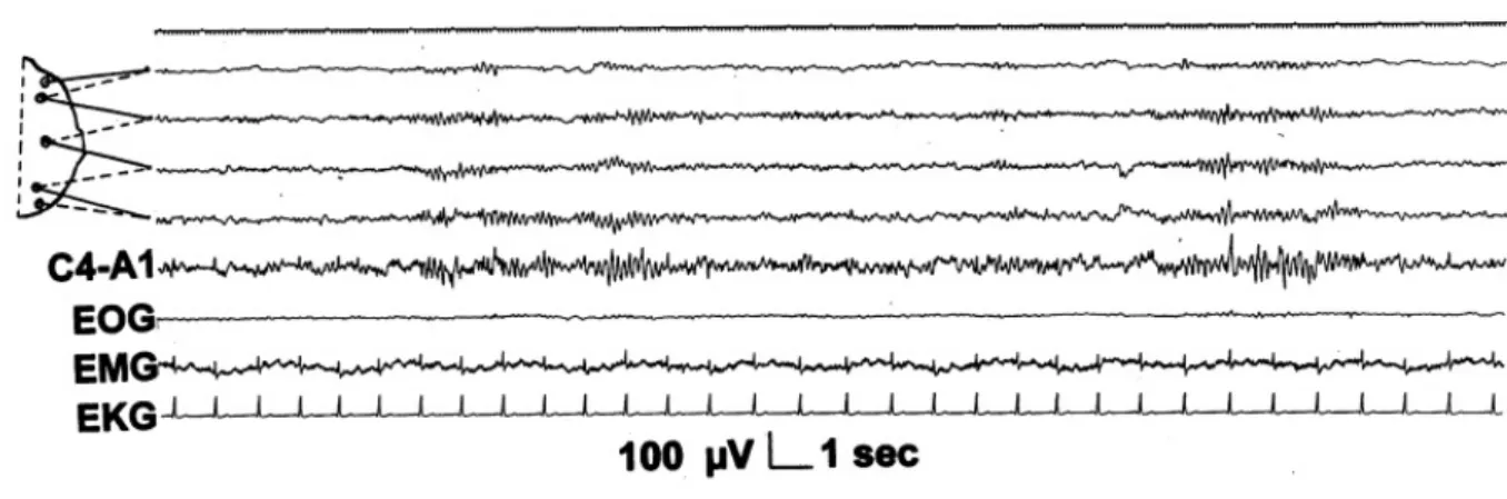 Figure 1.8: Intermittent alpha rhythm in stage 1 sleep. Top 5 channels: EEG derivation as in Figure 1.3 (Figure source: Sleep Medicine 3, Consensus Report, Mario Giovanni Terzano et al.: Atlas, rules, and recording techniques for the scoring of cyclic alte
