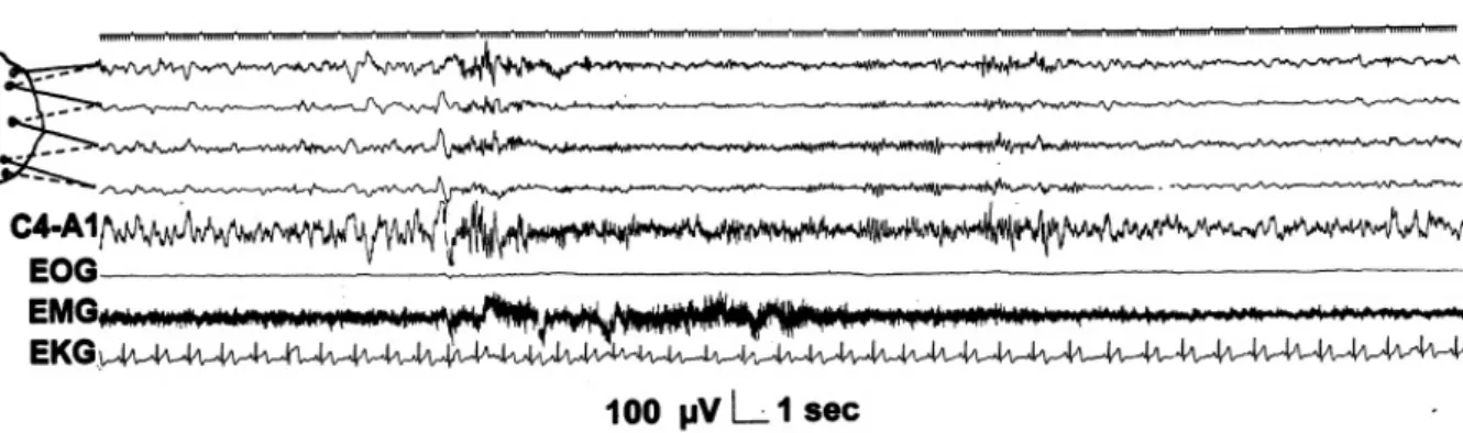 Figure 1.9: Arousal preceded and followed by sleep. Top 5 channels: EEG derivation as in Figure 1.3 (Figure source: Sleep Medicine 3, Consensus Report, Mario Giovanni Terzano et al.: Atlas, rules, and recording techniques for the scoring of cyclic alternat