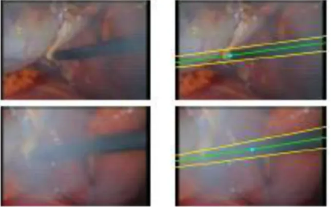 Fig. 1.7 Find the tip of the instrument by the straight edge.[16] 