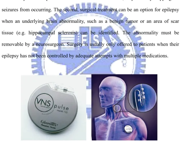 Fig. 1-2 Vagus nerve stimulation (VNS)  (From: http://www.medgear.org/page/4/) 