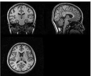 Figure 1.4: A 3-D magnetic resonance image of a human head. It is shown in the coronal, sagittal and axial views.