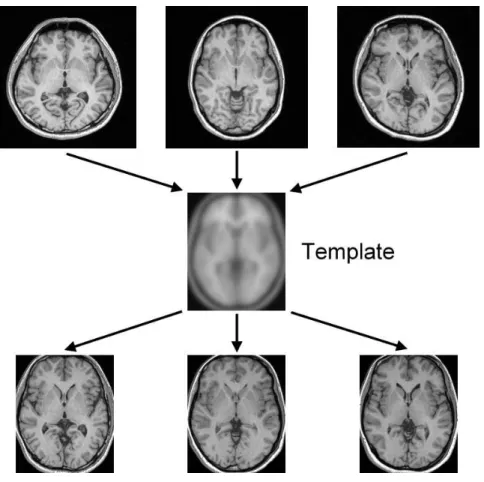 Figure 2.1: The normalization. Images in the upper row, the middle row and the lower row are native MR images, template image and normalized images respectively