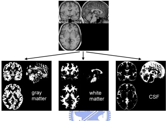 Figure 2.2: The segmentation. The figure shows segmentation of a normalized image into different tissue classes