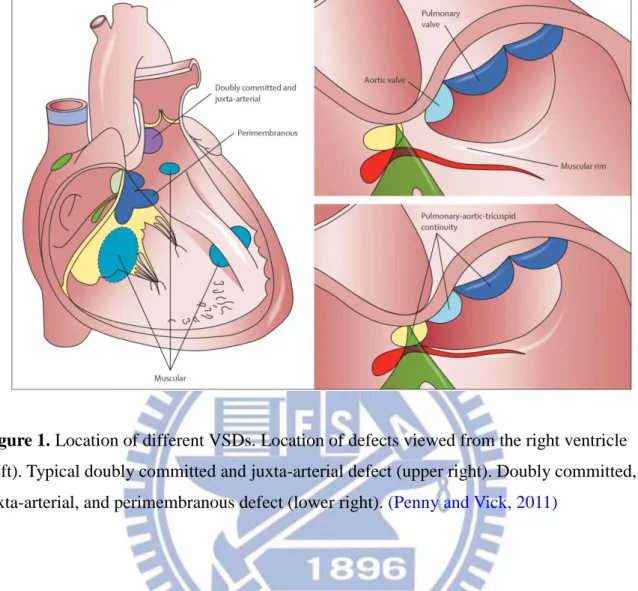 Figure 1. Location of different VSDs. Location of defects viewed from the right ventricle  (left)