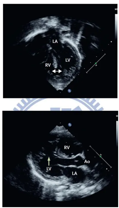 Figure 2. Echocardiograms of VSDs. Echocardiograms show apical four-chamber (A) and  parasternal long-axis view (B) of a large apical muscular defect (arrows)