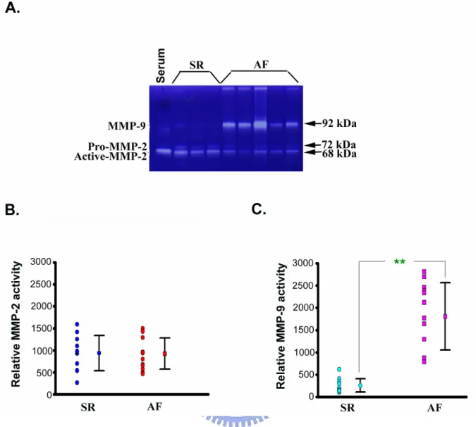 Figure 3. The induction of MMP-9 activity in the atria with AF. Gelatinolytic activity of MMP-2 and MMP-9 (92 kDa) in the SR (n = 12) and AF (n = 14) tissues were determined by zymographic analysis (20 μg per each determination) (A)