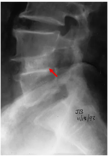 Figure 2.8: This radiograph demonstrates a solid bony union between L3 and L4  [27]. 