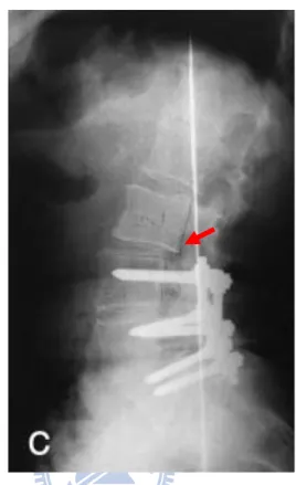 Figure 2.11: Adjacent segment degeneration disease developed at L2/3 after  5-year spinal fusion [36]