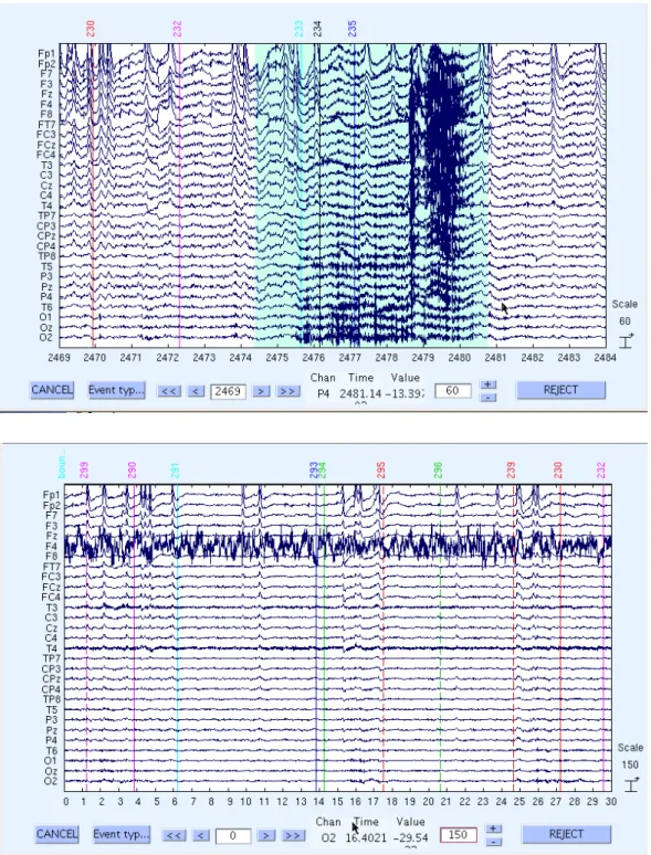 Figure 3-2: Pictures show the examples of common artifacts contaminated in the EEG  signals