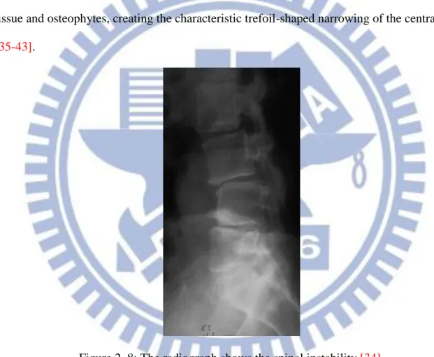 Figure 2. 8: The radiograph shows the spinal instability [34]. 