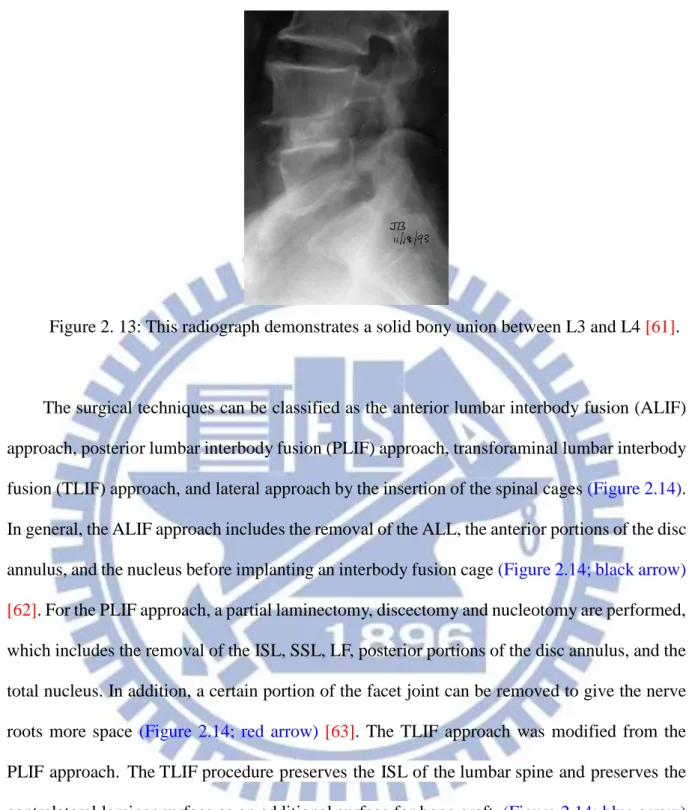 Figure 2. 13: This radiograph demonstrates a solid bony union between L3 and L4 [61]. 