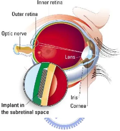 Fig. 1.4. The Sub-Retinal Implant. Reprinted from the internet: 